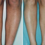 laser hair removal1