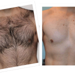 laser hair removal2