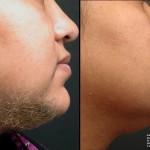 laser hair removal3